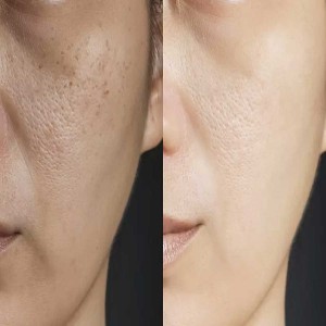 Open Pores Treatment in Vasant Kunj