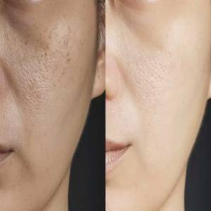 Open Pores Treatment in Jaipur