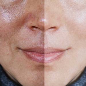 Open Pores Treatment in Delhi