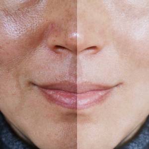 Open Pores Treatment in Delhi