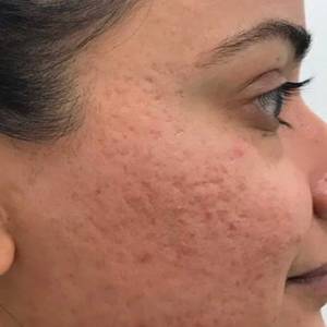 Open Pores Treatment in Mayur Vihar