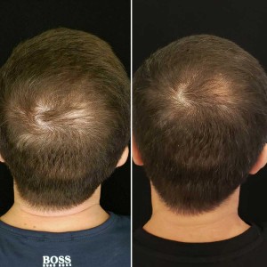 PRP Treatments for Hair Growth and Stop Hair Fall in Delhi