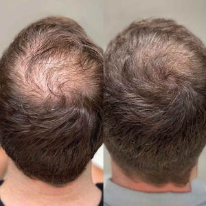 PRP Treatments for Hair Growth and Stop Hair Fall in Patel Nagar