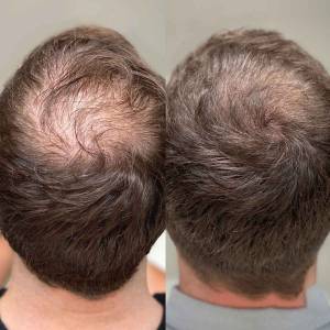 PRP Treatments for Hair Growth and Stop Hair Fall in Delhi
