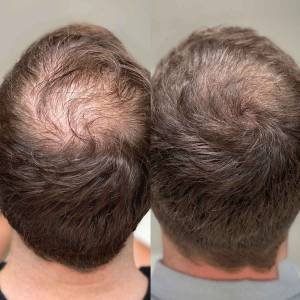 PRP Treatments for Hair Growth and Stop Hair Fall in Rajouri Garden