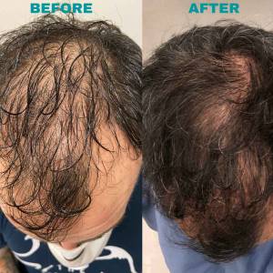 PRP Treatments for Hair Growth and Stop Hair Fall in Chandni Chowk