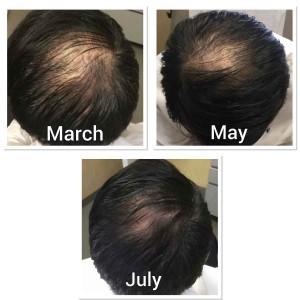 PRP Treatments for Hair Growth and Stop Hair Fall in Janakpuri