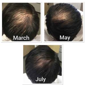 PRP Treatments for Hair Growth and Stop Hair Fall in Chandni Chowk