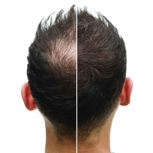 PRP Treatments for Hair Growth and Stop Hair Fall in Civil Lines
