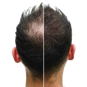 PRP Treatments for Hair Growth and Stop Hair Fall in Chandni Chowk