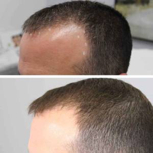 PRP Treatments for Hair Growth and Stop Hair Fall in Mayur Vihar