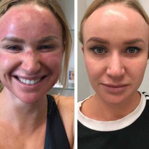 PRP for Facial Glow Skin Tightening Removal of Fine Lines and Wrinkles in Preet Vihar