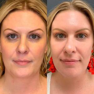 PRP for Facial Glow Skin Tightening Removal of Fine Lines and Wrinkles in Hauz Khas