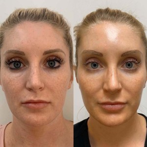 PRP for Facial Glow Skin Tightening Removal of Fine Lines and Wrinkles in Pritam Vihar