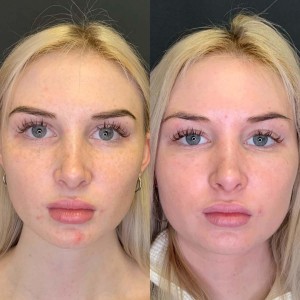PRP for Facial Glow Skin Tightening Removal of Fine Lines and Wrinkles in Greater Kailash