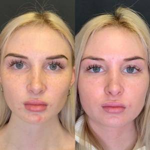 PRP for Facial Glow Skin Tightening Removal of Fine Lines and Wrinkles in Preet Vihar