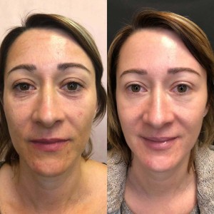 PRP for Facial Glow Skin Tightening Removal of Fine Lines and Wrinkles in Karawal Nagar
