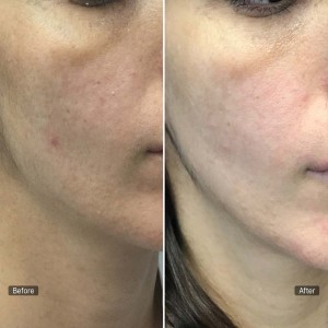 PRP for Facial Glow Skin Tightening Removal of Fine Lines and Wrinkles in Patel Nagar