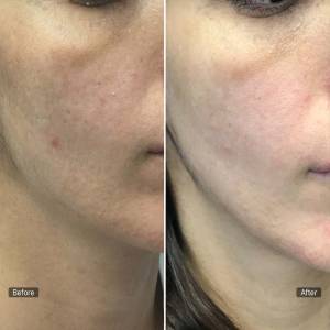 PRP for Facial Glow Skin Tightening Removal of Fine Lines and Wrinkles in Preet Vihar