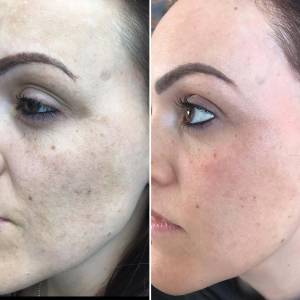 PRP for Facial Glow Skin Tightening Removal of Fine Lines and Wrinkles in Preet Vihar