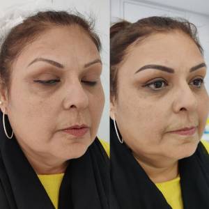 Permanent Eyebrow Enhancement in Agra
