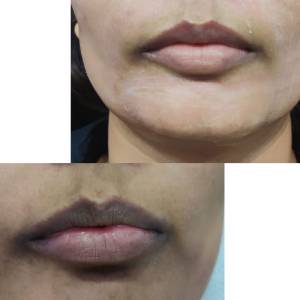 Permanent Lip Coloring in Delhi