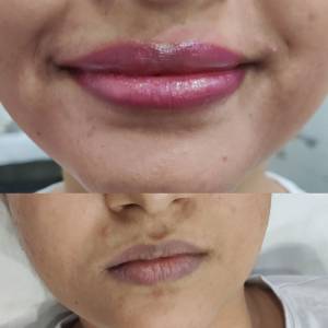 Permanent Lip Coloring in Delhi