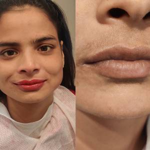 Permanent Lip Coloring in Delhi