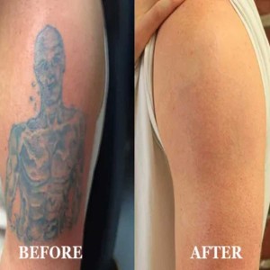 Permanent Tattoo Removal in Gurgaon