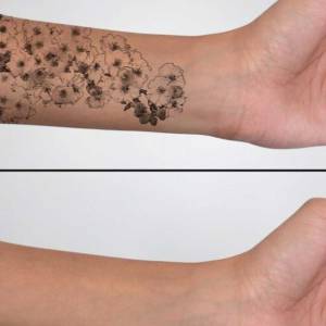 Permanent Tattoo Removal in Najafgarh