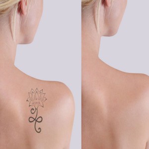 Permanent Tattoo Removal in Connaught Place