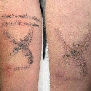 Permanent Tattoo Removal in Vivek Vihar