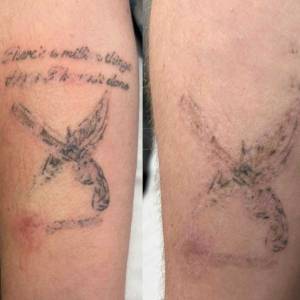 Permanent Tattoo Removal in Chandni Chowk