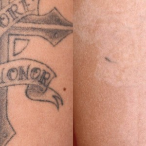 Permanent Tattoo Removal in India