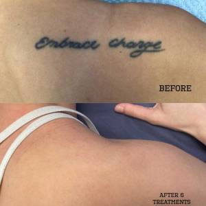 Permanent Tattoo Removal in Defence Colony