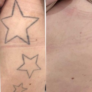 Permanent Tattoo Removal in Defence Colony