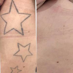 Permanent Tattoo Removal in Karawal Nagar