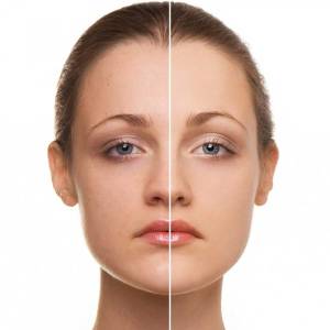 Photo Facial for Skin Lightening in Lajpat Nagar