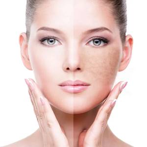 Pigmentation treatment in Karol Bagh