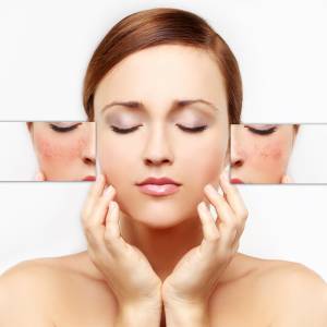 Pigmentation treatment in Nehru Place