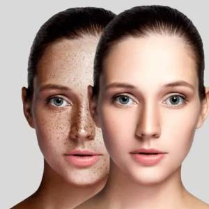 Pigmentation treatment in Mehrauli