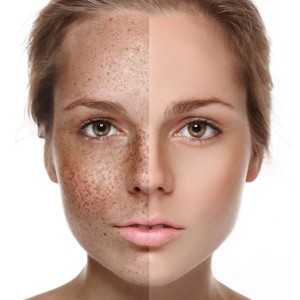 Pigmentation treatment in Greater Kailash