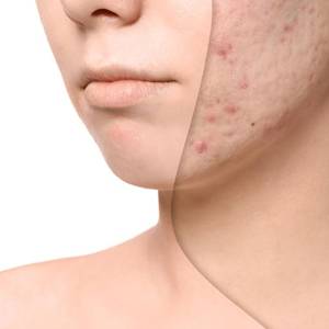 Pimple Treatment in Vasant Vihar