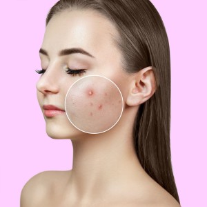 Pimple Treatment in Okhla
