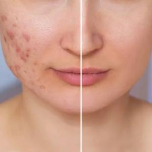 Post Acne Scars Removal in Chandni Chowk