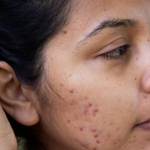 Post Acne Scars Removal in Punjabi Bagh