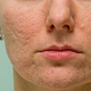Post Acne Scars Removal in Okhla