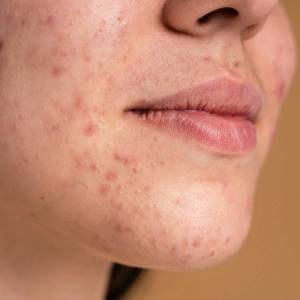 Scars and Pits Treatment in Delhi