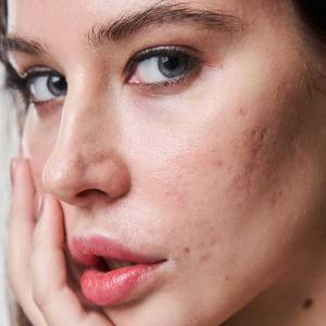 Scars and Pits Treatment in Delhi