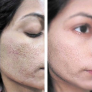 Scars and Pits Treatment in Delhi